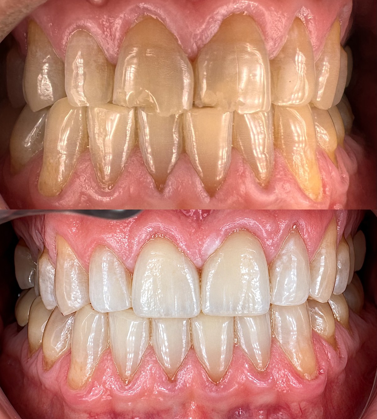 Before and after combined veneers and full mouth whitening on an actual patient: worn, discolored upper and lower teeth above, and the brighter, restored teeth below