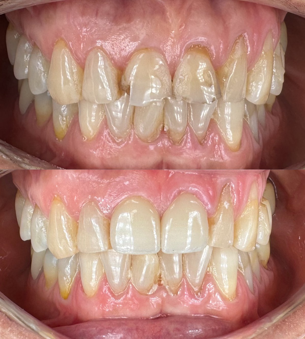 Before and after veneers with crown lengthening on an actual patient: chipped, worn upper and lower front teeth above, and the brighter, restored teeth below