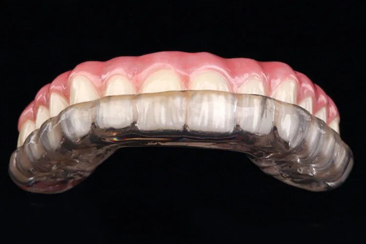 A custom-fit occlusal guard resting on a dental model