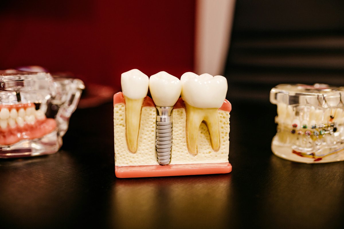 Dental model showing an implant fixture in the jaw bone, with a natural tooth beside it