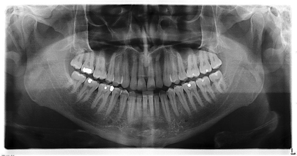 A panoramic digital dental X-ray
