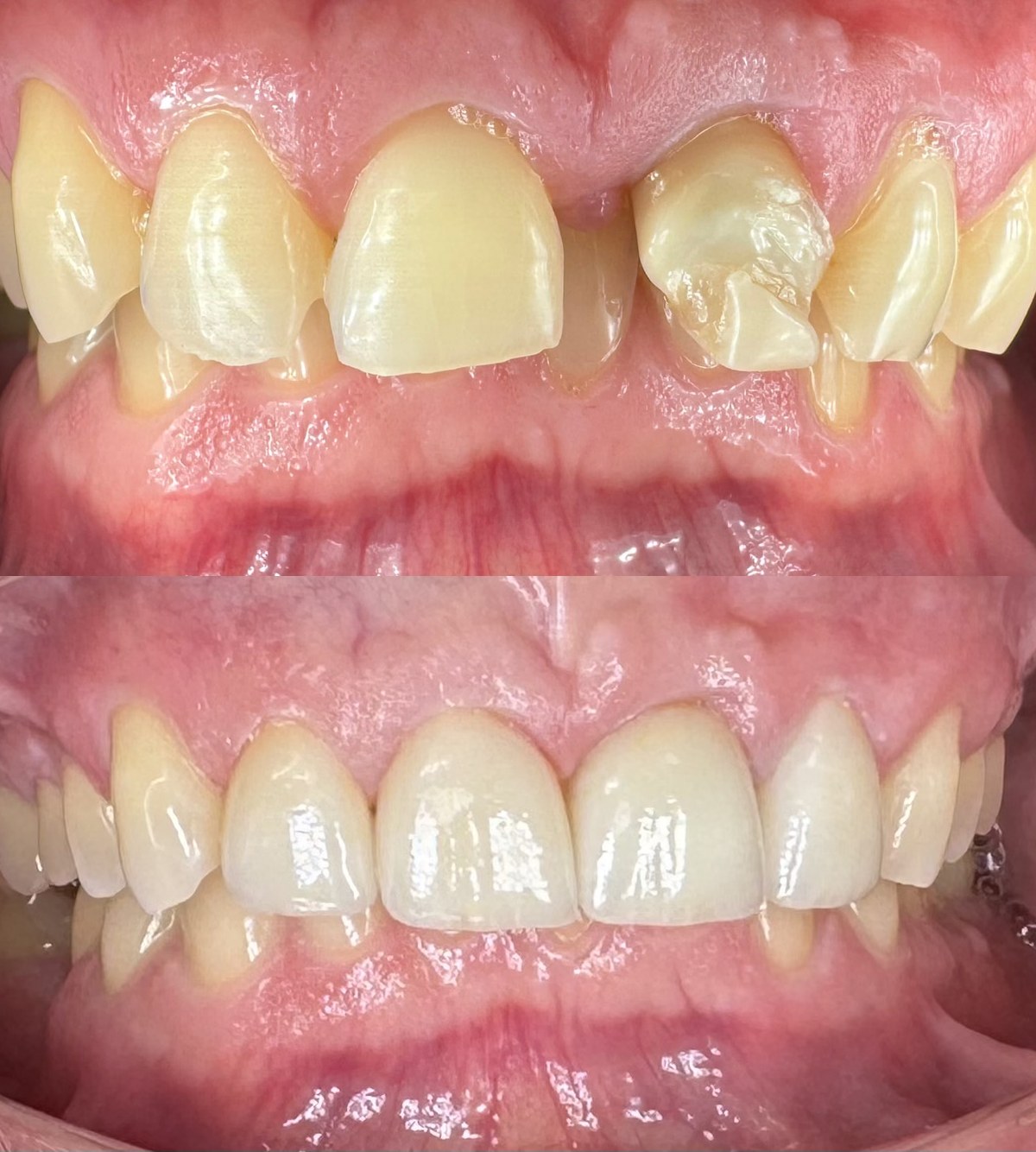 Before and after porcelain veneers on an actual patient: worn, uneven front teeth above, and the finished veneer result below